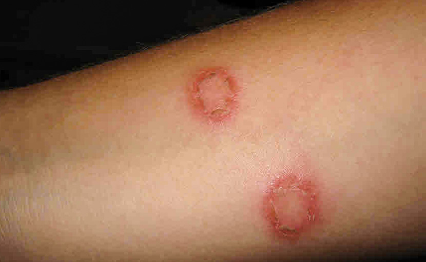 দাদ বা রিংওয়ার্ম | চর্মরোগটির লক্ষণ, কারণ ও প্রতিকার কী?