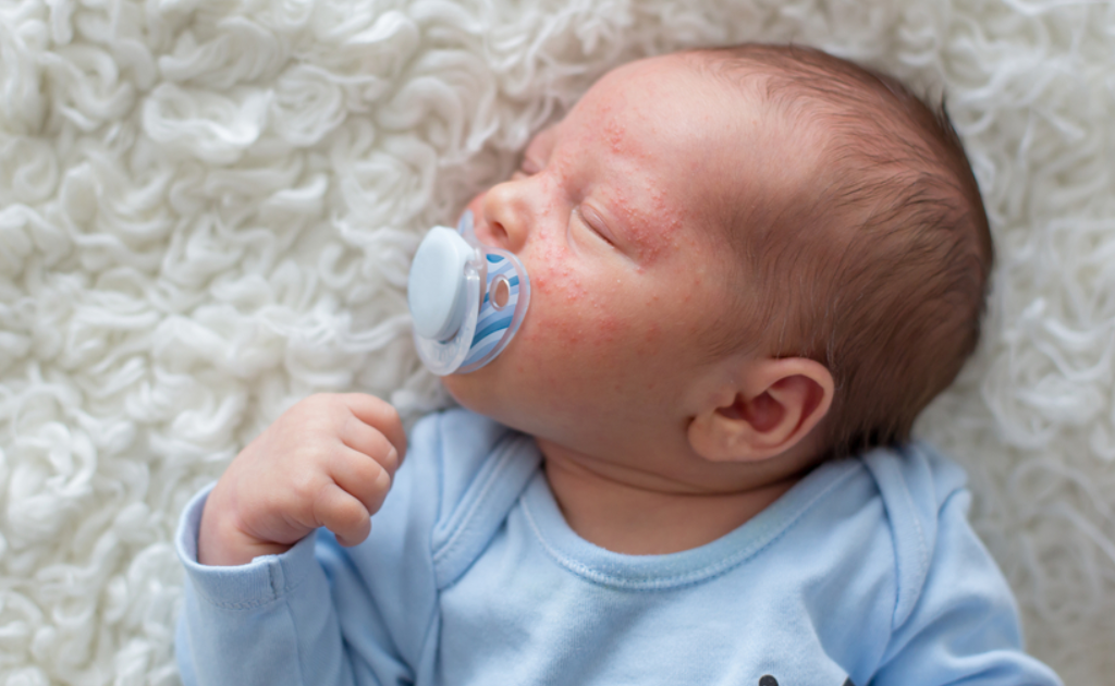 নবজাতকের চর্মরোগ হলে বাবা-মায়ের করণীয় কী?