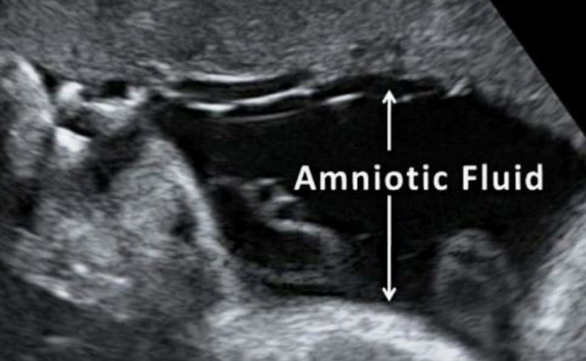 গর্ভাবস্থায় পানি ভাঙ্গা সম্পর্কে কতটুকু জানেন?