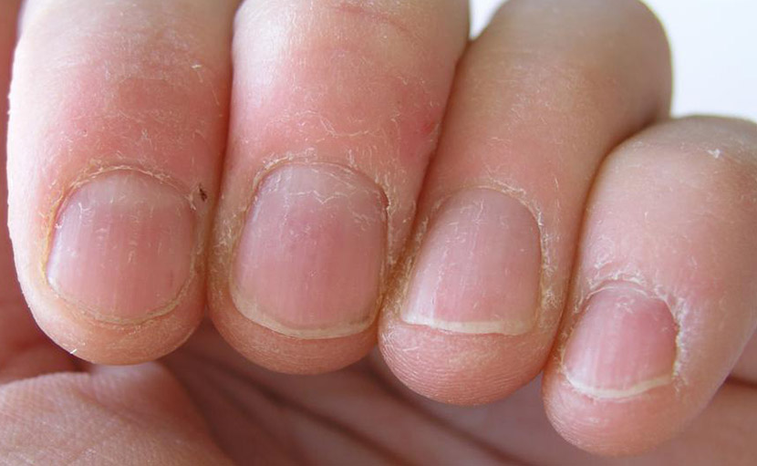 দাঁত দিয়ে নখ কাটা | অস্বাস্থ্যকর বদভ্যাসটির কারণ ও বন্ধ করার ৭টি টিপস