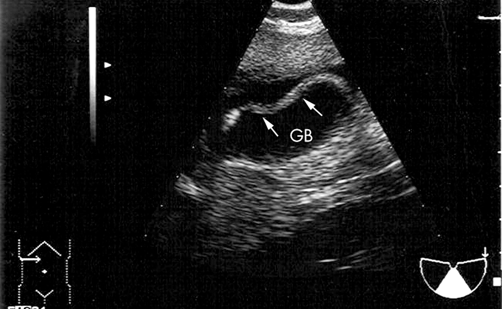 পিত্তথলিতে কৃমি | পেট ব্যথার জন্য এই কারণটি দায়ী নয় তো?