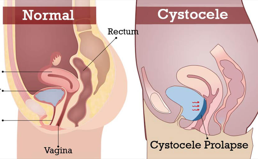 জরায়ু নিচে নেমে যাওয়া | ইউটেরাইন প্রলাপ্স এর ধরণ, কারণ ও চিকিৎসা কী?