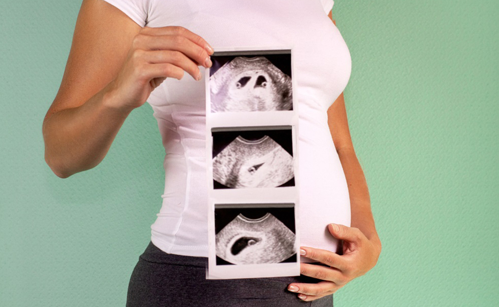 টুইন প্রেগনেন্সি | মাতৃগর্ভে যমজ শিশু থাকলে কী কী জটিলতা দেখা দেয়?