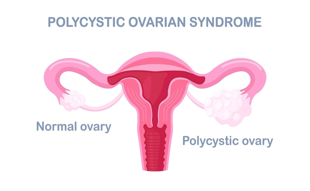 পিসিওএস (PCOS) কী এবং এ রোগে কোন ধরনের খাবার খাবেন?